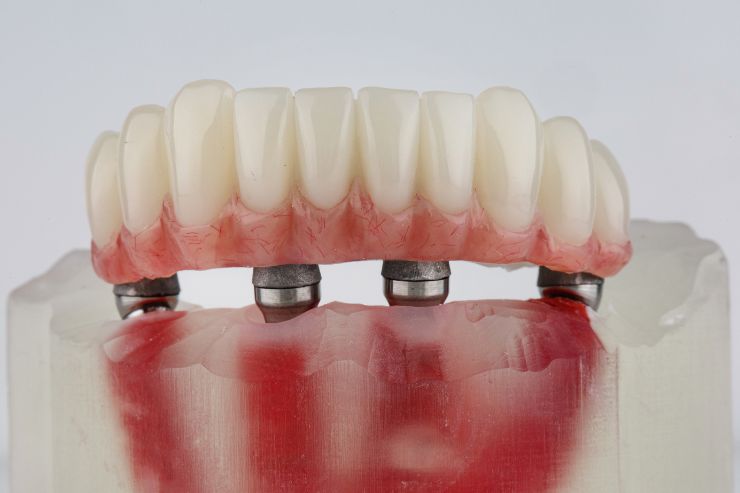 Dental Bridges Haripriya Multispeciality Dental Clinic, Dr. Uma Sundari Popuri