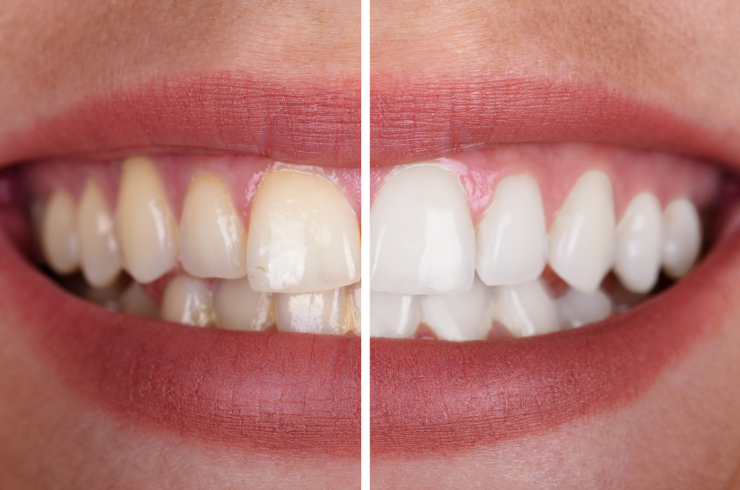 Teeth Whitening Haripriya Multispeciality Dental Clinic, Dr. Uma Sundari Popuri
